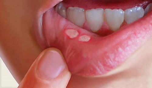 Bệnh lở miệng là bệnh gì?