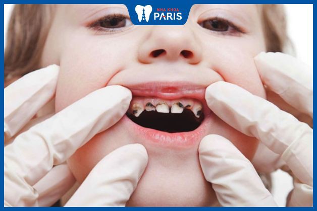 Bệnh sâu răng ở trẻ nhỏ là gì?