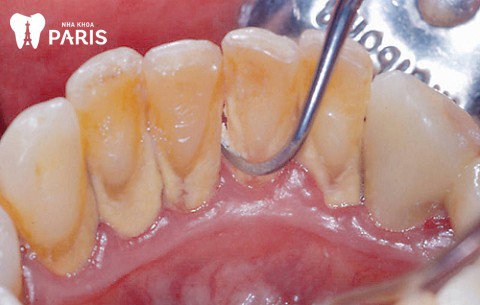 Lấy cao răng là cách chữa chảy máu chân răng triệt để tận gốc