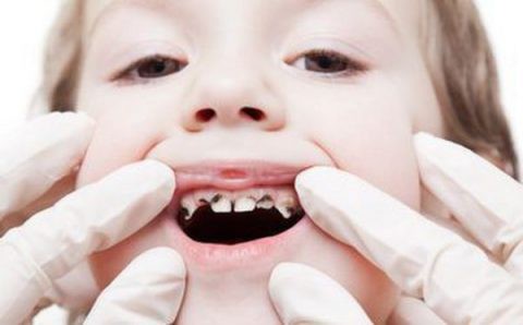 Nhổ răng sâu không đúng cách có thể gây ra một số biến chứng không đáng có.
