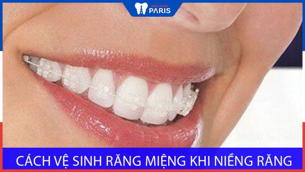 Cách vệ sinh răng miệng khi niềng răng: Một số lưu ý quan trọng