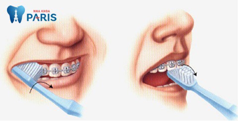 Cách vệ sinh răng miệng khi niềng răng đúng cách sẽ đảm bảo răng được đẹp và chắc khỏe