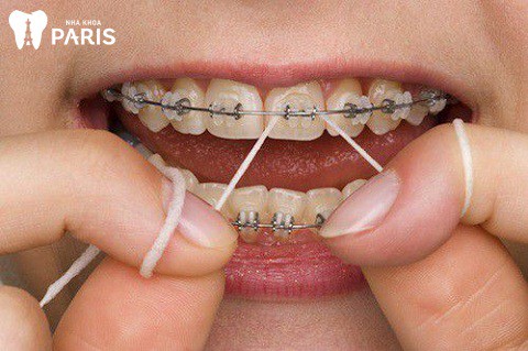Cách vệ sinh răng miệng khi niềng răng - sử dụng chỉ nha khoa