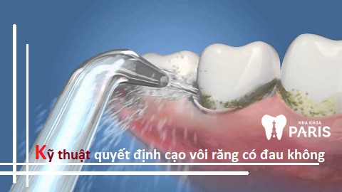 cạo vôi răng có đau không?
