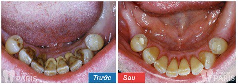 Khách hàng Nguyễn Thu Hương sau khi lấy cao răng công nghệ siêu âm Cavitron BP 8.0 tại Nha khoa Paris. 