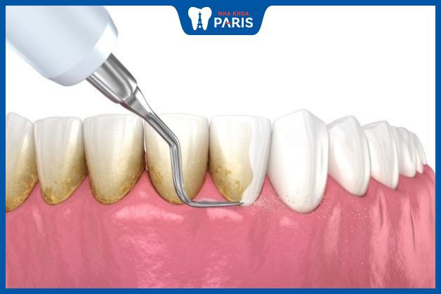 Cao răng là nguyên nhân chủ yếu gây ra tình trạng hôi miệng