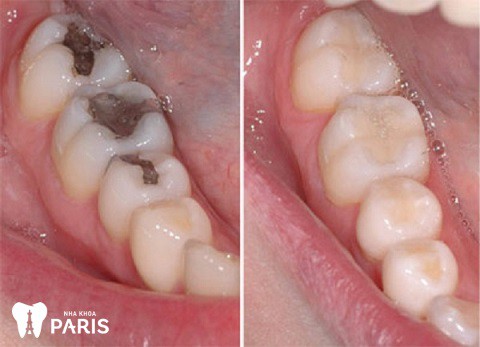 Bọc răng sứ là giải pháp tốt nhất trong trường hợp sâu răng chạm tới tủy