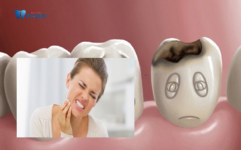 Đau răng hàm dưới hầu hết là do sâu răng