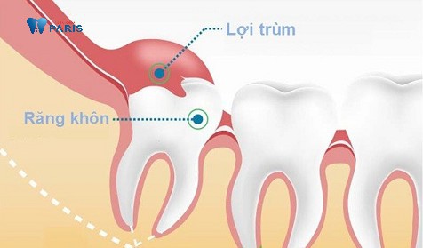 Viêm lợi trùm là biến chứng của mọc răng khôn. 