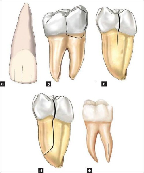 Hình ảnh răng bị nứt dọc thân