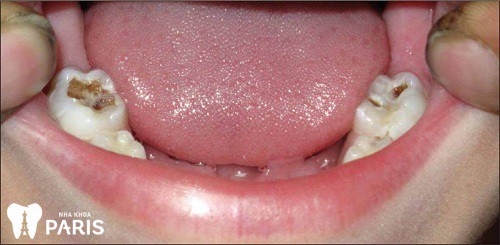 Hình ảnh sâu răng hàm ở bé giai đoạn 2, xuất hiện những vệt đen trên thân răng