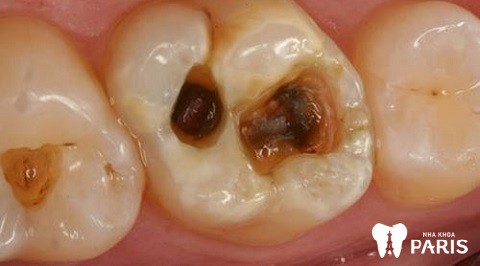 Các lỗ sâu răng sẽ ngày càng lớn hơn, gây tổn hại cấu trúc răng nhiều hơn