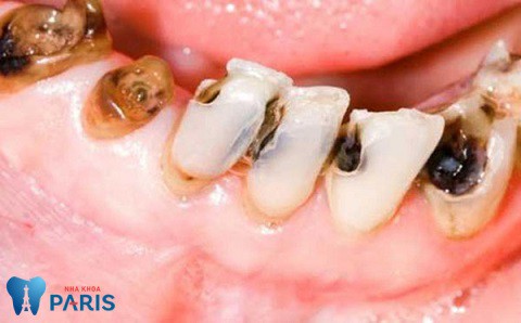 HÌnh ảnh sâu răng phát triển nặng, gây nguy cơ mất răng cao