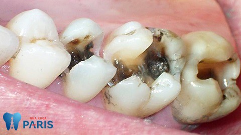 Hình ảnh sâu răng gây viêm tủy, chết tủy