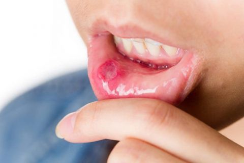 Đốm trắng mọc thành chùm ở mặt trong nướu, lợi là dấu hiệu điển hình của bệnh lở miệng.