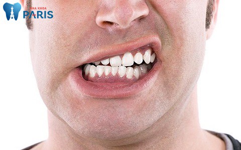Máng chống nghiến răng Nhật Bản giúp bạn tránh khỏi nhiều nguy cơ gây hại