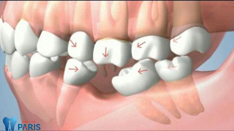 Nhổ răng cấm có ảnh hưởng gì không?