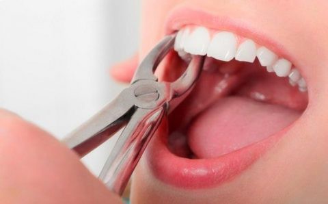 Nhổ răng cấm hàm trên sai cách có thể gây viêm xoang hàm.