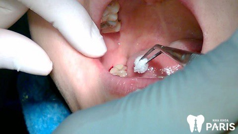 Nhổ răng khôn 1 tuần vẫn đau do đâu?