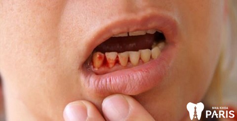 Nhổ răng khôn 1 tuần vẫn đau do chải răng sai cách