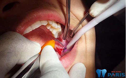 Nhổ răng khôn bị đau đầu phần lớn do kỹ thuật của bác sĩ.