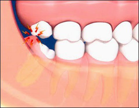 Răng khôn hàm trên không có răng khôn hàm dưới chặn lại có thể trồi lên quá mức.