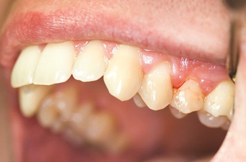 Răng bị bệnh lý lung lay