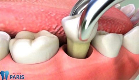 nhổ răng số 6 có đau không theo chuyên gia