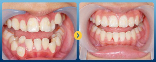 Hiệu quả của phương pháp niềng răng với trường hợp răng lồi xỉ
