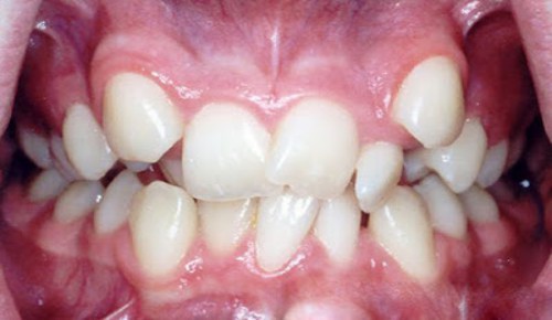 Hiện tượng răng bị lòi sĩ khiến hàm răng mất tính thẩm mỹ