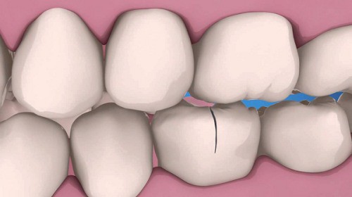 Răng bị nứt dọc liệu có hàn trám được không?