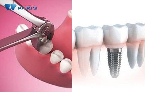 Nhổ răng kết hợp trồng răng implant cho răng hàm sâu bị vỡ. 