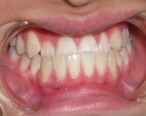Tình trạng "răng quặp ki bo"
