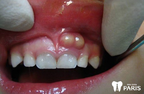Sâu răng ăn vào tủy có thể gây áp xe răng, ảnh hưởng nghiêm trọng đến sức khỏe răng miệng