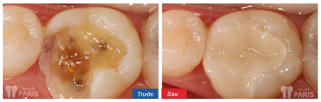 Bọc răng sứ là giải pháp tốt nhất khắc phục sâu răng ăn vào tủy