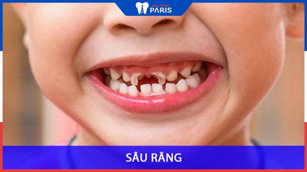 Sâu răng – Bệnh lý răng miệng nguy hiểm cần đặc biệt lưu ý