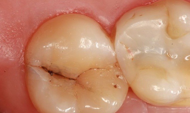 Sâu răng hàm thời kỳ đầu xuất hiện những đốm đen li ti