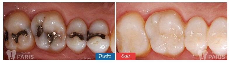 Sâu răng nên làm gì? Bọc răng sứ