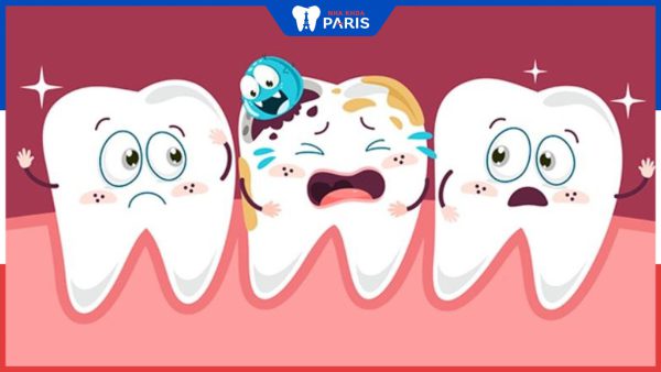 Sâu răng nên làm gì để tránh tái phát nặng hơn