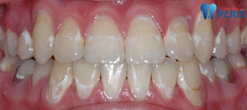 Sâu răng - Bệnh lý răng miệng Hết Sức Nguy Hiểm cần đặc biệt lưu ý 21