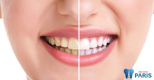 Sâu răng - Bệnh lý răng miệng Hết Sức Nguy Hiểm cần đặc biệt lưu ý 13