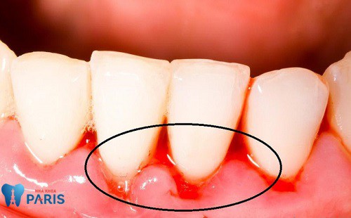 Sâu răng - Bệnh lý răng miệng Hết Sức Nguy Hiểm cần đặc biệt lưu ý 12
