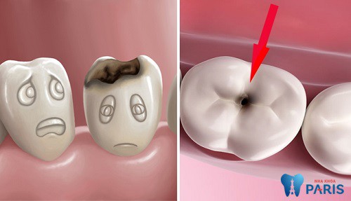 Sâu răng - Bệnh lý răng miệng Hết Sức Nguy Hiểm cần đặc biệt lưu ý 8