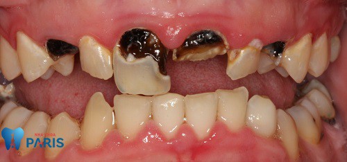 Sâu răng - Bệnh lý răng miệng Hết Sức Nguy Hiểm cần đặc biệt lưu ý 7