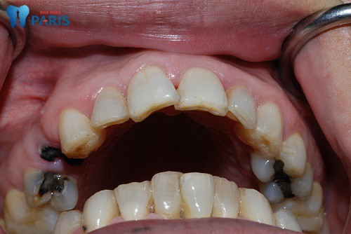 Sâu răng - Bệnh lý răng miệng Hết Sức Nguy Hiểm cần đặc biệt lưu ý 6