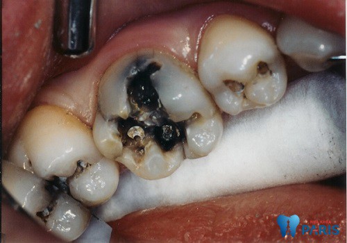 Sâu răng - Bệnh lý răng miệng Hết Sức Nguy Hiểm cần đặc biệt lưu ý 5