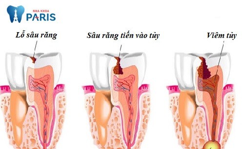Sâu răng dẫn đến viêm tủy là nguyên nhân gây đau đầu