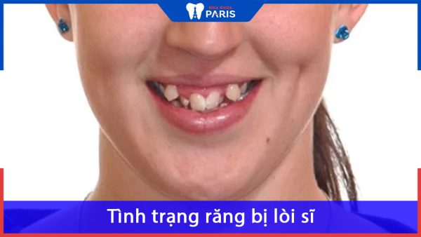 Tình trạng răng bị lòi sĩ là như thế nào? Nha khoa Paris