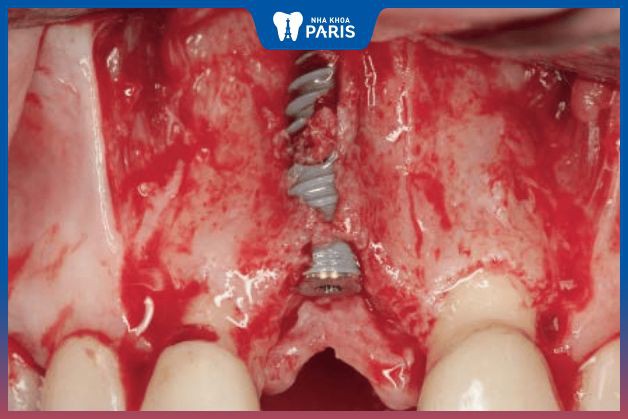 Răng implant làm hỏng màng xương