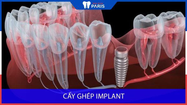 Các Biến chứng thường gặp khi trồng Implant, Nha khoa paris